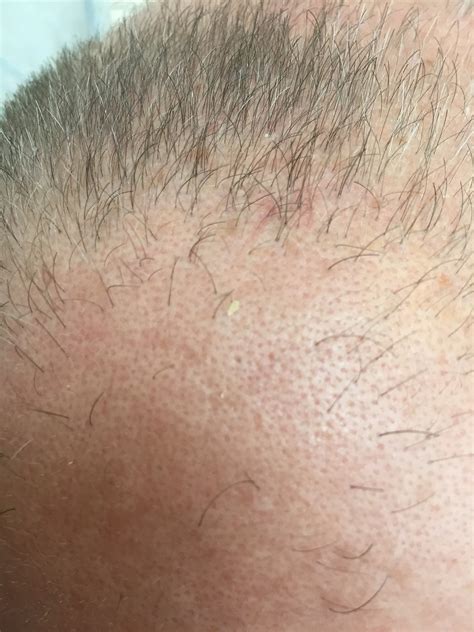 head bald  photo  pixabay pixabay