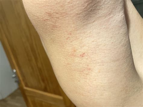 Post scabies or reinfection? Showers still itch, also evening itching