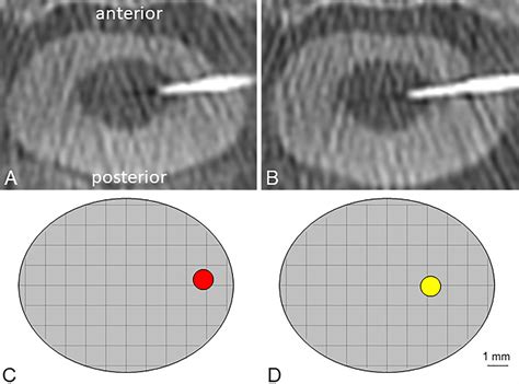 Somatotopic organization of the human spinothalamic tract: in vivo