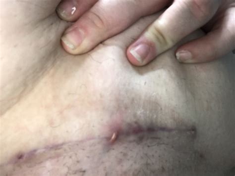 Cesarean Incision Infection