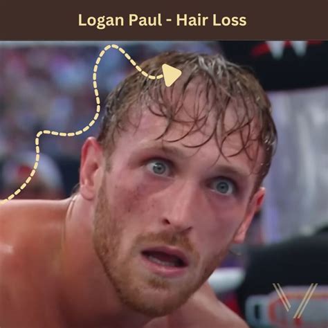 Logan Paul Hair Transplant