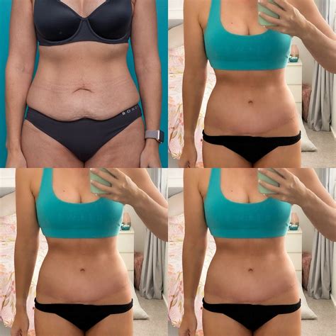 Best Bikini Bottoms For Tummy Tuck Scars at Carrie Hernandez blog