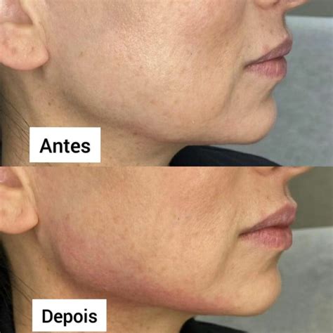 Preenchimento De Mandíbula Antes E Depois - Preenchimento Mandíbula Antes e Depois - Clínica Fit Body Estética
