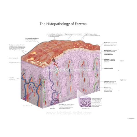 Eczema Illustrations | Dermatitis | Skin Inflammation | Medical ...