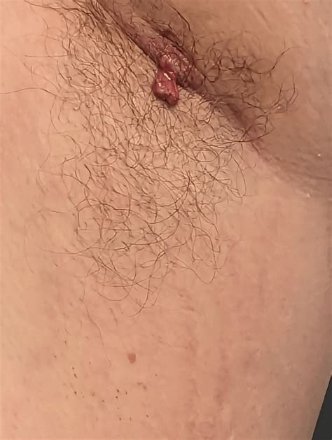 Angry armpit cyst or boil : r/popping