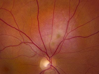 atlas entry circumscribed choroidal hemangioma