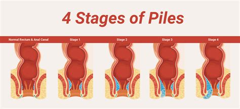 How does Piles Look like - Stages of Piles Pictorial Representation