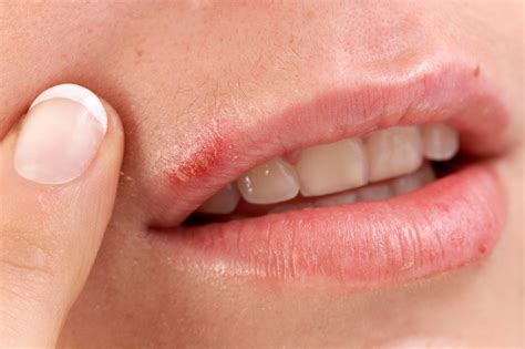 Cold sores - causes, symptoms and treatment | healthdirect