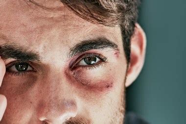 What is the black eye club on TikTok? Conspiracy theory explained | The ...