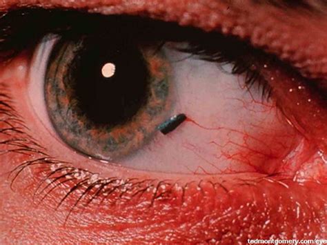 Conjunctival Foreign Body