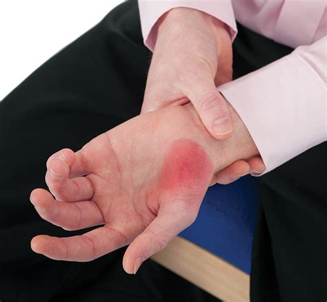 Common causes of superficial burns and scalds – E-Learning
