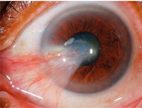 Pterygium Surfer's Eye - Pterygium (Surfer’s Eye): Causes and Risks Factors Explained - Eyeonce ...