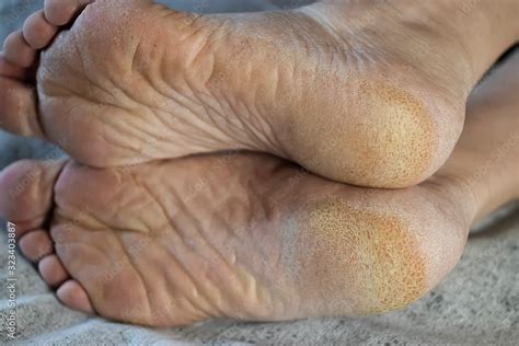 Feet of a patient with diabetes. Diabetic foot. Hyperkeratosis and ...