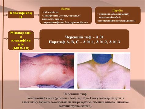 Черевний тиф. Паратифи А і В. Харчові токсикоінфекції. Сальмонельоз ...