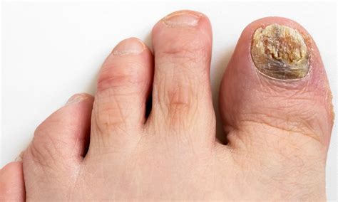 toenail fungus treatment   treat feet podiatry
