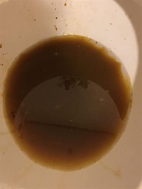 What Does Gray Diarrhea Mean at Albert Jarman blog