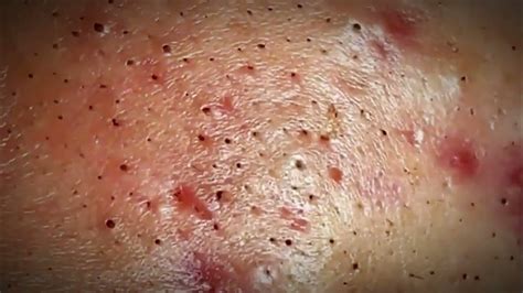 Warning: This Unbelievable Blackhead Removal 2024 Method is Highly Addictive! - uyq8et9