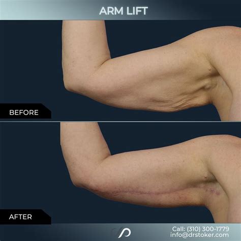 Arm Lift Surgery: Say Goodbye to Loose Skin