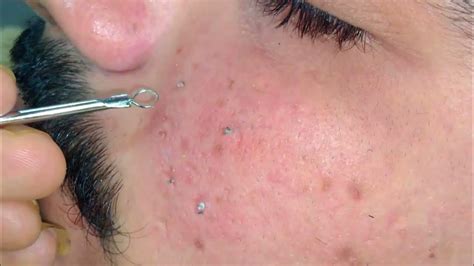 This 2024 Blackhead Removal Method Changed My Life (Seriously!) - zqy0428