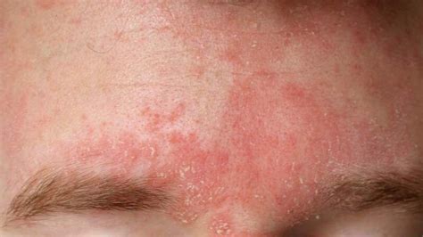 Facial Eczema: Symptoms, Causes, Treatments, and More
