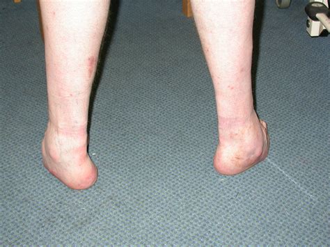 DSCN3081 - The Foot and Ankle Clinic