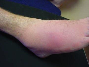 Gout In the Ankle | The Worst Joint For An Attack!