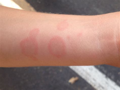 urticaria hives skin reaction  occurs  response grepmed