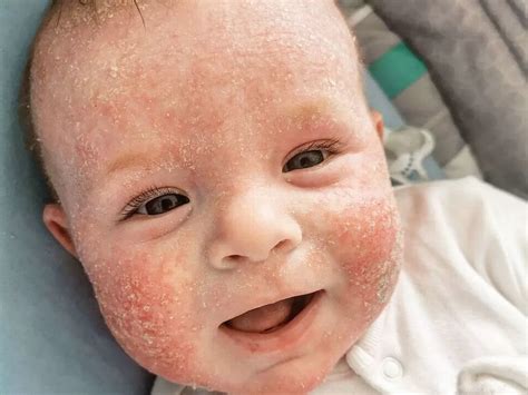 lactose allergy skin rash milk allergy rash pictures images