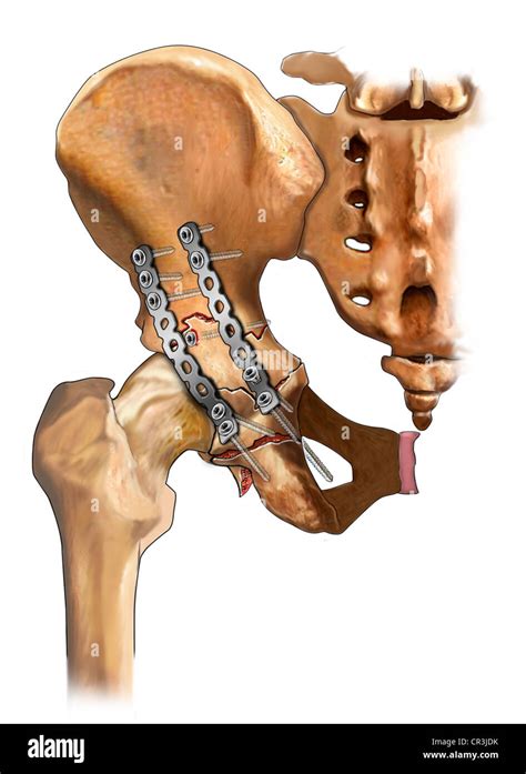 acetabular fracture