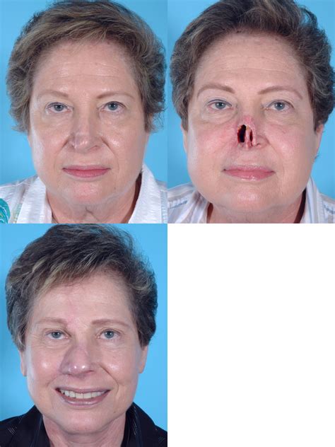 NASAL RECONSTRUCTION GALLERY « Wolfe