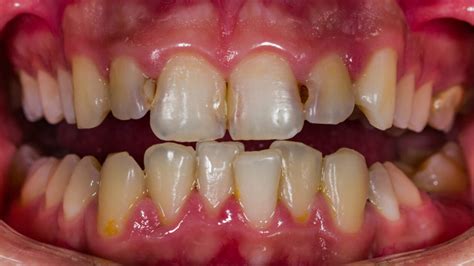 Front tooth decay treatment - Dr Jamilian