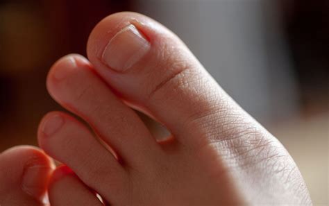 Blister Under Your Toenail? Here's How To Treat It