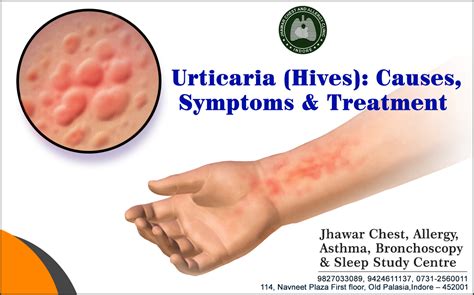 urticaria hives  symptoms treatment