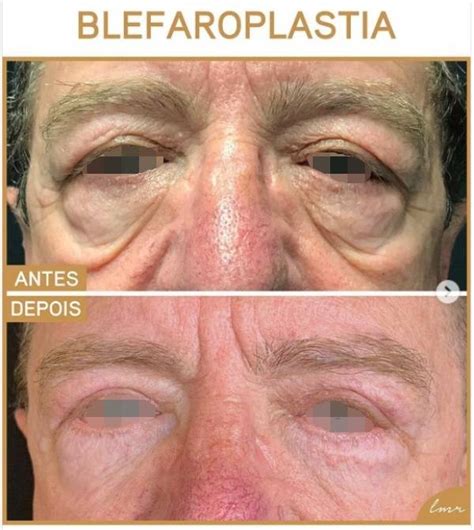 O Que É Blefaroplastia - 45 Fotos de Blefaroplastia Antes e Depois do Procedimento