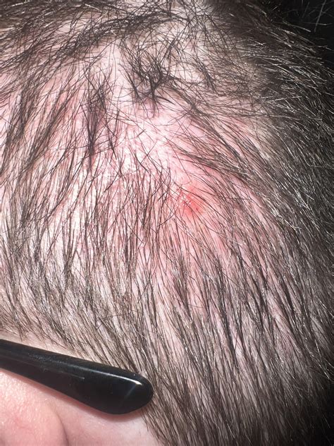 Bump on scalp? : r/DermatologyQuestions