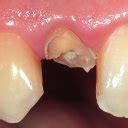 (left) Root canal filling of the maxillary right lateral incisor ...