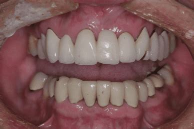 vertical dimension confusion  dr leonard hess dds