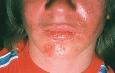 Herpes Simplex 1 On Face Pictures - Fobiaalaenuresis