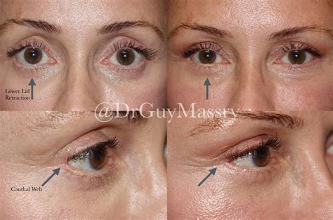 Dana's Revision Eyelid Surgery - Dr Guy MassryCosmetic Eyelid Surgery ...