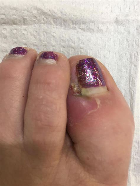 Infected Toenail From Pedicure