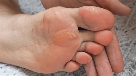 Corns And Calluses: Causes, Symptoms, Treatment And Prevention ...