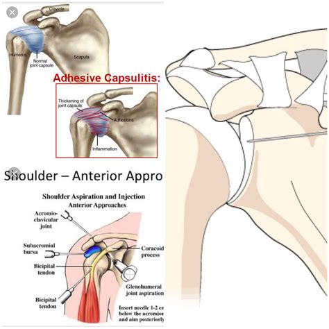 Shoulder Pain Treatment in Indirapuram