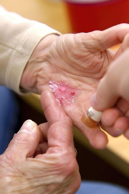 Premium Photo | An individual applying soothing cream to alleviate discomfort caused by a red ...