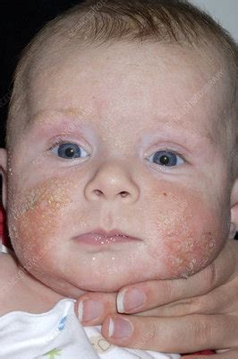 Infected eczema on a baby's face - Stock Image - M150/0302 - Science ...