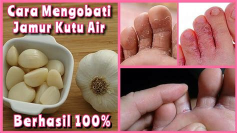 mengobati kutu air  bawang putih perumperindocoid