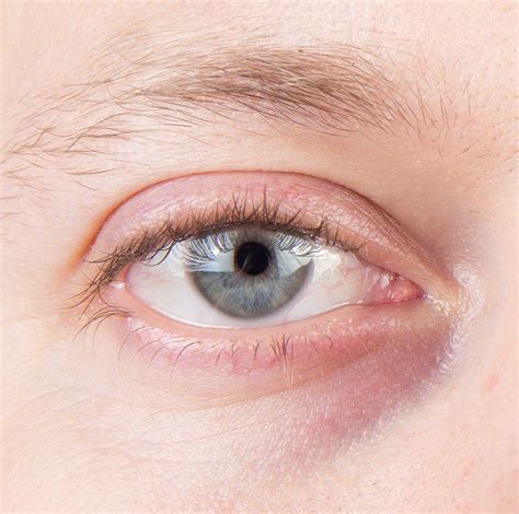 Quels sont les différents types de cernes ? Comment prévenir leur