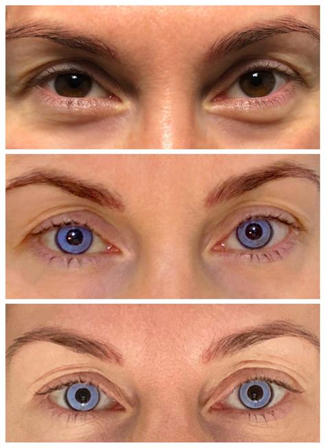Results and Examples — Eye Color Change — KERATO