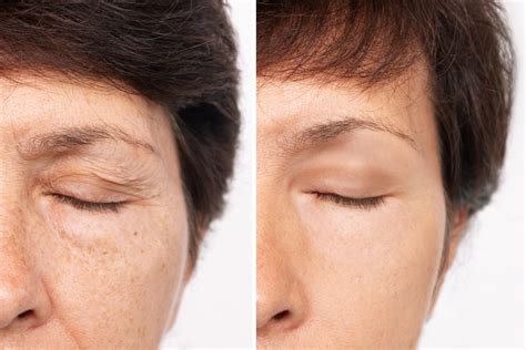 Blepharoplasty Scars: Healing Time & How to Minimize Them