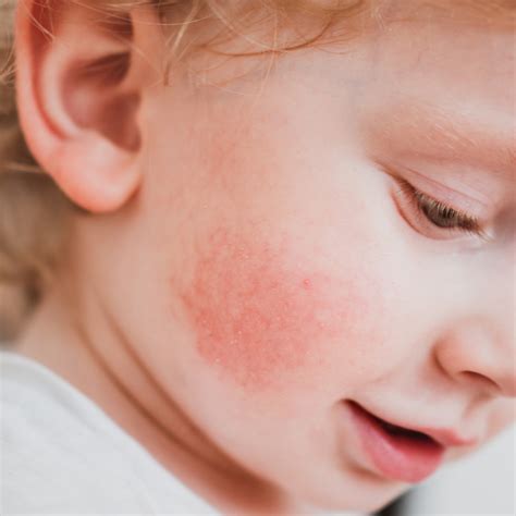 Heeft mijn baby een koemelkallergie?