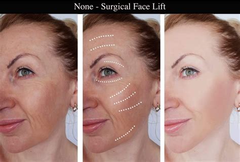 Non-Surgical Face Lift | Skin Clinic Marlow, Buckinghamshire